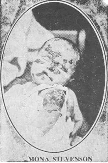 Mona Stevenson of Humphrey St. Burnley, England, was vaccinated at the age of five weeks by Dr. J. W. Clegg, with the official glycerinated calf-lymph, after five weeks of suffering in which the childs face and arm was partly eaten away by the vaccine disease, the child died. The same doctor certified the cause of death as "generalized vaccinia, 36 days, and exhaustion."