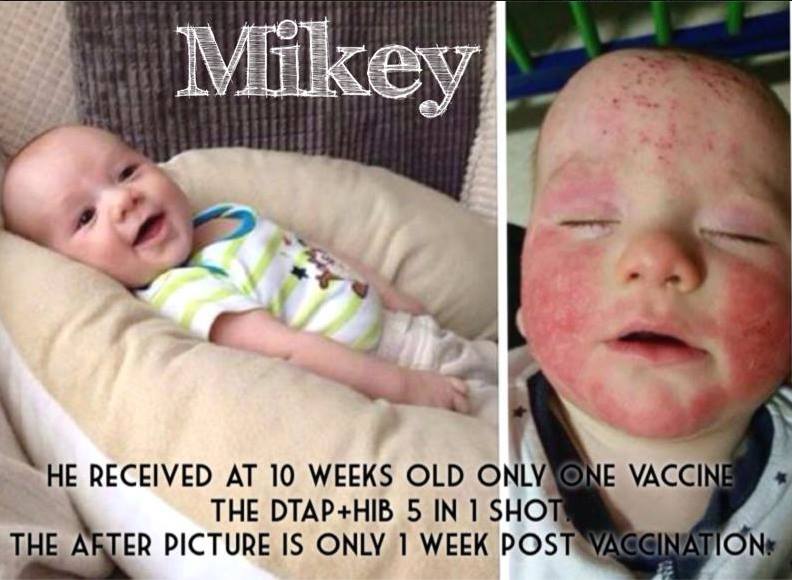 Eczema and vaccines